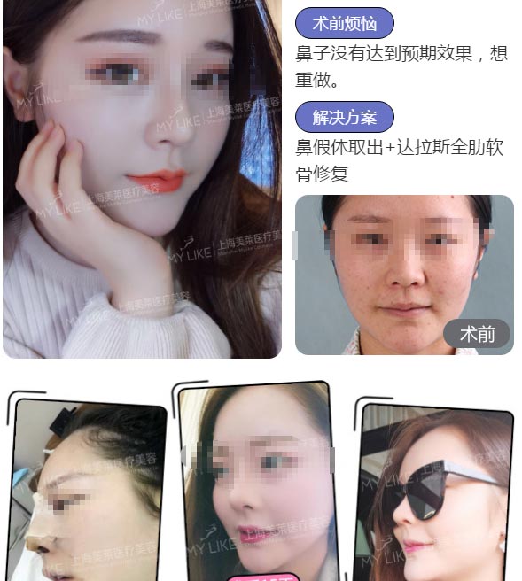 上海美莱隆鼻修复案例