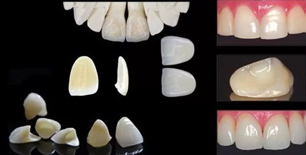 美莱牙贴面能同时解决多种牙齿问题吗