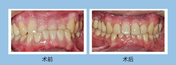 美莱隐形矫正案例
