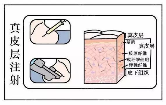 【上海美莱20周年庆】喷香水也会产生颈纹吗