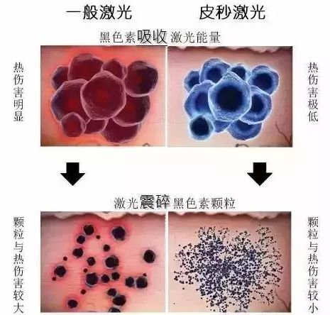 上海蜂巢皮秒祛斑效果怎么样