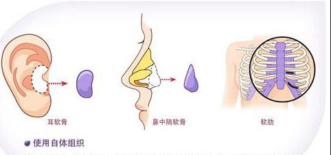 自体软骨隆鼻后，软骨会被吸收吗
