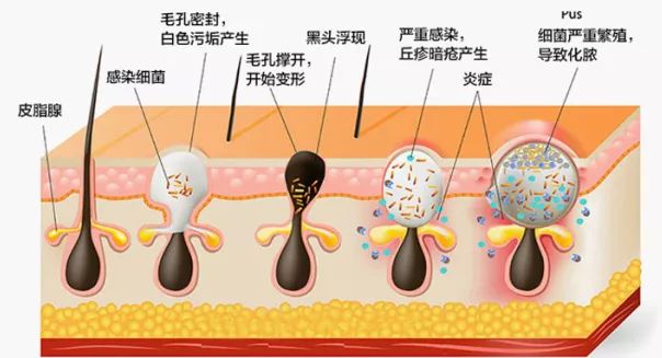 草莓鼻怎样能治好