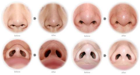 鼻孔缩小手术后影响鼻子呼吸吗