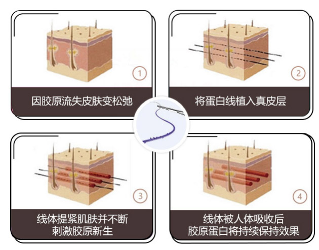 面部提升除皱术美莱申涛做的好不好