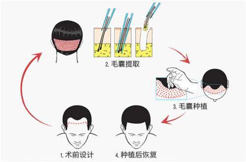 上海植发医院美莱种植头发安全吗