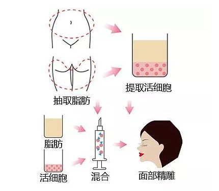 美莱自体脂肪技术有什么好的优势