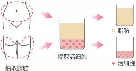 做完面部填充后会不会出现下垂