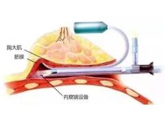 上海做双平面隆胸术特点有哪些