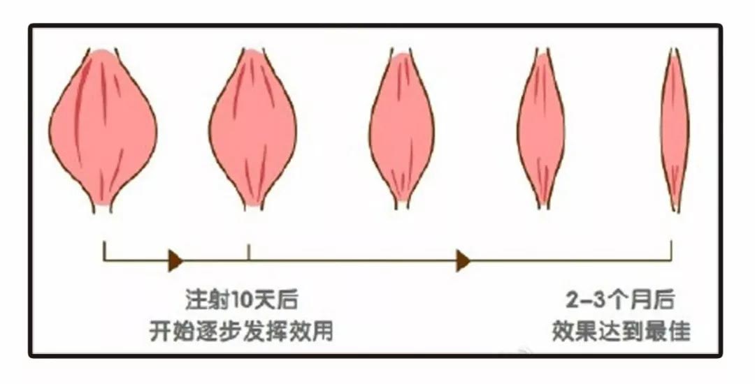 上海美莱瘦脸产品 选对方法重中之重