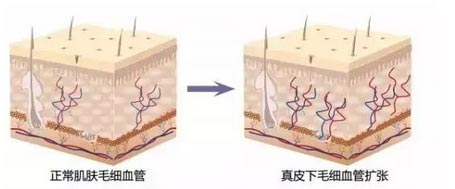 脸部红血丝光子嫩肤如何进行去除