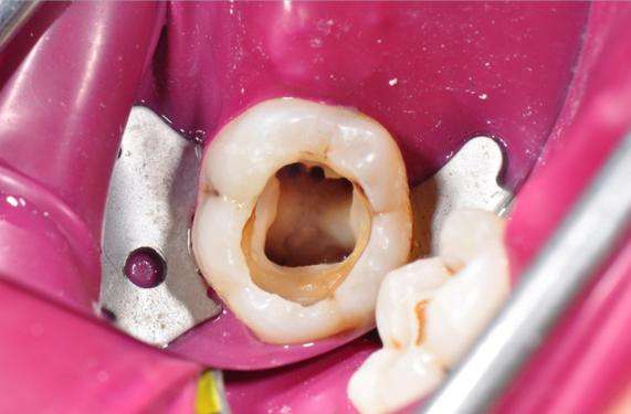 刷牙能把蛀牙细菌都消灭掉吗