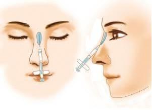 美莱注射隆鼻常用的材料是什么