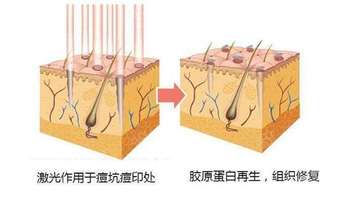 上海做点阵激光祛痘效果好不好