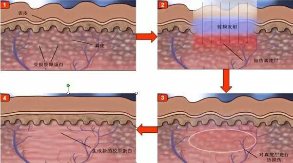 美莱射频可以去除黑眼圈吗