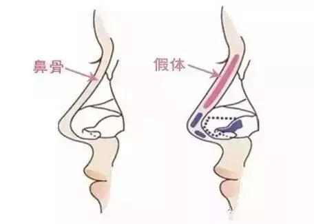 膨体隆鼻手术多少钱