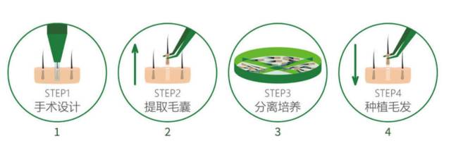 美莱发际线如何调整