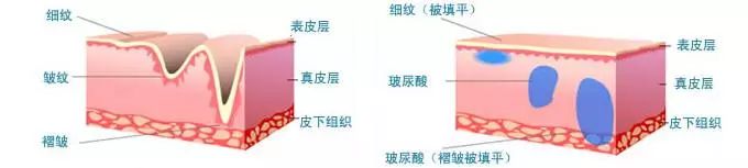 美莱除皱方法这么多,到底怎么选才好