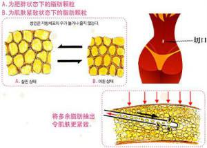 上海做腹部抽脂会留疤吗