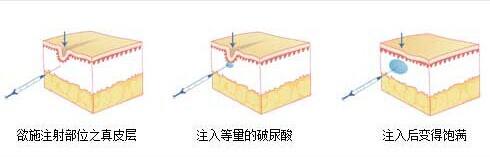 做注射隆鼻适合哪类人