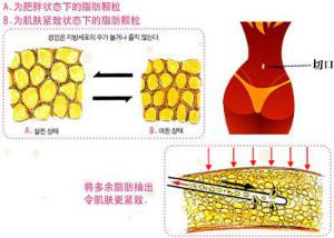 做完腹部抽脂手术之后塑身衣要穿多久