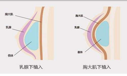 上海隆胸医院，美莱隆胸效果怎么样