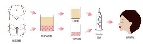 上海做垫下巴手术用什么材料效果好