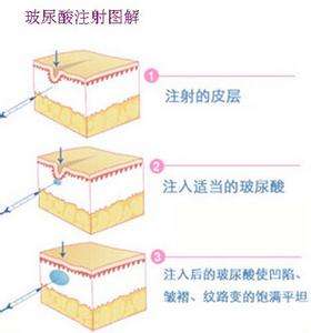 美莱科普:玻尿酸填充会因为代谢而凹凸不平吗