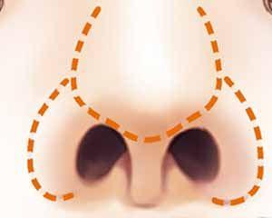 鼻翼缩小后会影响鼻子呼吸吗
