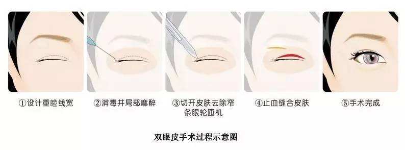 [上海美莱咨询]现在做双眼皮要花多少钱