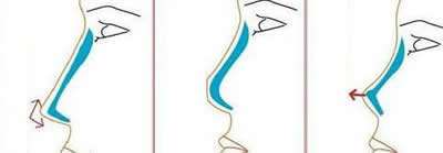 假体隆鼻做完后假体会出现移位情况吗