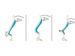 假体隆鼻做完后假体会出现移位情况吗