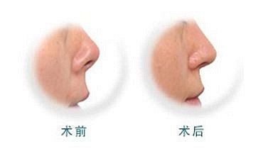 上海美莱做朝天鼻矫正手术效果如何