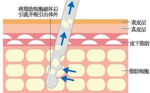 【美莱科普】冬天适合做吸脂吗