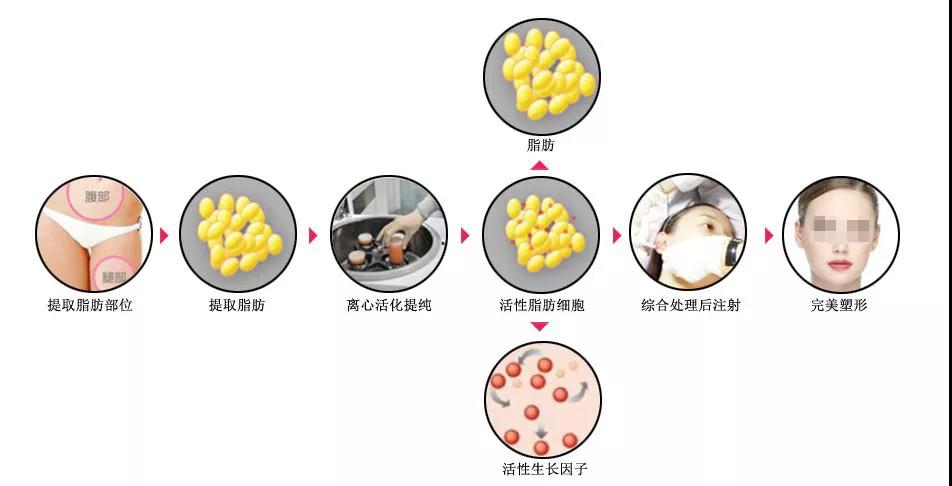 上海做自体脂肪填充优缺点有哪些