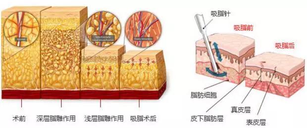 做减肥塑形通过吸脂真的可以吗