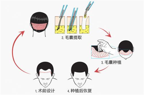 上海做植发手术的价格是多少