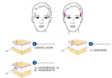 上海做玻尿酸丰太阳穴有什么好处