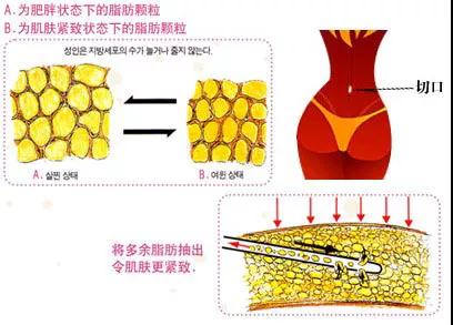 上海做吸脂减肥会对身体造成什么伤害吗