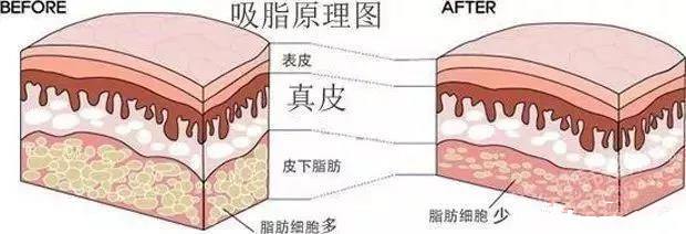 上海做大腿吸脂有没有什么影响