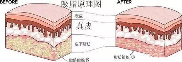 上海做大腿吸脂有没有什么影响