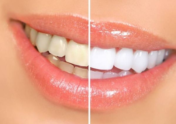 做了冷光美白牙齿会有哪些其他影响吗