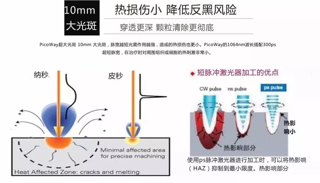 美莱超皮秒去斑|美容界超舒服祛斑产品