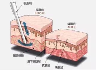 美莱做了大腿吸脂后一般能瘦多少