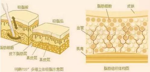 美莱做了大腿吸脂后一般能瘦多少