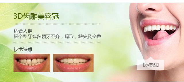 上海地区做美容冠矫正牙齿多少钱