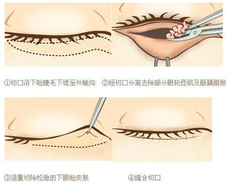 做超声波去眼袋大概需要多少钱