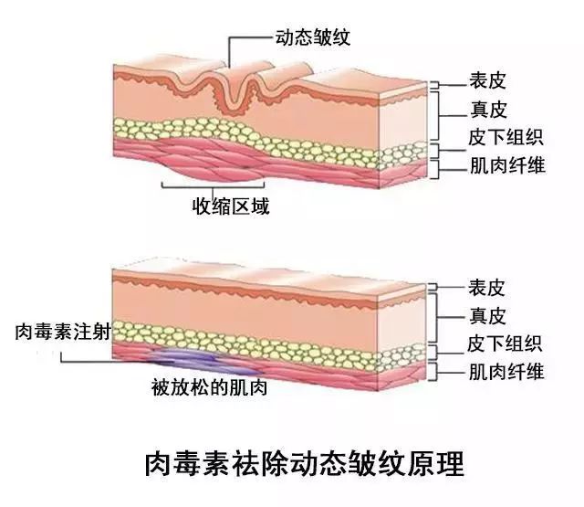 【美莱微整形除皱】你的“一条皱纹”出来没