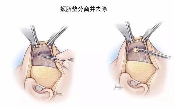 上海地区做去颊脂垫一般需要多少钱