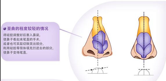 歪鼻矫正价格贵吗，需要多少钱